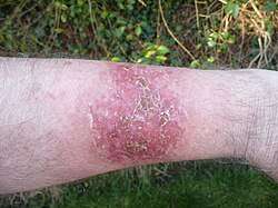Male forearm showing oval scabbed skin patch with scales and reddening