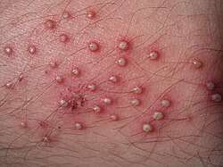 Folliculitis