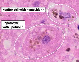 Histopathology of the liver, showing a Kupffer cells with significant hemosiderin deposition next to a hepatocyte with lipofuscin pigment. H&E stain.