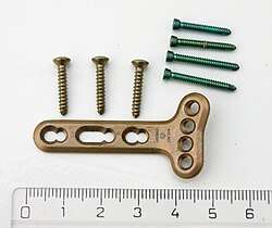 Screws and plate with ruler